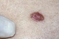 Basal Cell Carcinoma Royalty Free Stock Photo