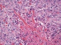 Histopathology ofBasal Cell Carcinoma