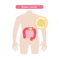 Bowel Cancer flat illustration.