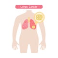 Lungs cancer diagram .Vector illustration in flat style.