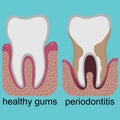 Difference between healthy gums and gums with periodontitis