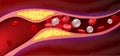 Arteries with clogged fat that causes blood clots.