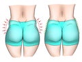 Comparison of love handles on a woman body