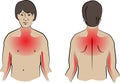 Heart Attack Pain Locations medical illustration