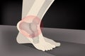 Arthritis is a common cause of foot pain
