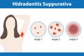 Hidradenitis Suppurativa Royalty Free Stock Photo