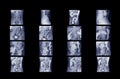 BE or barium enema double contrast.