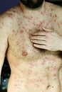 Man with chickenpox Royalty Free Stock Photo