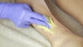 Beautician remov unwanted leg hair with shugaring. Epilation process