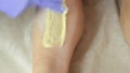 Beautician remov unwanted leg hair with shugaring. Epilation process