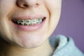 Beautiful caucasian young girl in dental braces smiles. Teenage concept. Design of braces on teeth. Banner for dental clinic. Royalty Free Stock Photo