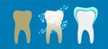 Beautiful flat dentist vector set of teeth cleansing process with decayed, cleansed and white shiny teeth on blue background