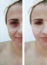 Beautiful girl face wrinkles, acne beautician medicine patient before and after the procedure