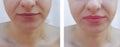 Beautiful girl face lip enlargement before and after procedureseffect