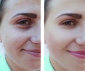 Beautiful girl wrinkles, acne removal on the face before and after procedures