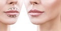 Lips of adult woman before and after augmentation