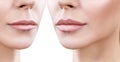 Lips of adult woman before and after augmentation