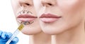 Lips of adult woman before and after augmentation.