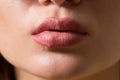 Beautiful lips virus infected herpes