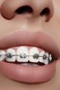 Beautiful white teeth with braces. Dental care photo. Woman smile with ortodontic accessories. Orthodontics treatment