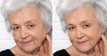 Beautiful mature woman before and after biorevitalization