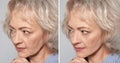 Beautiful mature woman before and after biorevitalization procedure on grey background