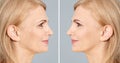 Beautiful mature woman before and after biorevitalization procedure on grey