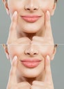 Beautiful pink lips after filler injection collagen to increase