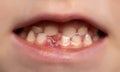 Beautiful smile of a child without one tooth. Change of milk teeth. Extraction of teeth for children in surgical dentistry, close-