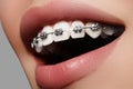 Beautiful white teeth with braces. Dental care photo. Woman smile with ortodontic accessories. Orthodontics treatment