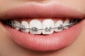 Beautiful white teeth with braces. Dental care photo. Woman smile with ortodontic accessories. Orthodontics treatment