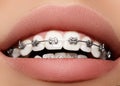 Beautiful white teeth with braces. Dental care photo. Woman smile with ortodontic accessories. Orthodontics treatment Royalty Free Stock Photo