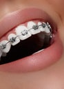 Beautiful white teeth with braces. Dental care photo. Woman smile with ortodontic accessories. Orthodontics treatment