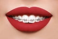 Beautiful white teeth with braces. Dental care photo. Woman smile with ortodontic accessories. Orthodontics treatment Royalty Free Stock Photo