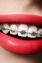 Beautiful white teeth with braces. Dental care photo. Woman smile with ortodontic accessories. Orthodontics treatment