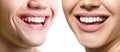 Beautiful wide smiles with great healthy white teeth of laughing man and woman. Smiling happy people. Laughing female and male