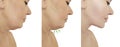 Beautiful woman double chin lift before and after correction liposuction procedureslifting Royalty Free Stock Photo