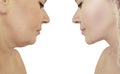 Beautiful woman double chin lift before and after correction procedures Royalty Free Stock Photo
