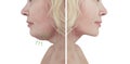 Beautiful woman double chin collage before and after liposuction procedures
