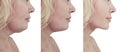 Beautiful woman double chin saggy rejuvenation collage before and after liposuction procedures Royalty Free Stock Photo