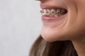 Beautiful young girl with metal dental braces with white teeth