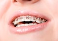 Beautiful young woman with brackets on teeth Royalty Free Stock Photo