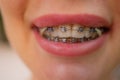 Beautiful young woman with brackets on teeth close up. Royalty Free Stock Photo