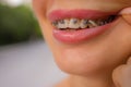 Beautiful young woman with brackets on teeth close up. Royalty Free Stock Photo