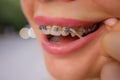 Beautiful young woman with brackets on teeth close up. Royalty Free Stock Photo