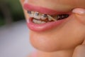 Beautiful young woman with brackets on teeth close up. Royalty Free Stock Photo