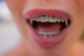 Beautiful young woman with brackets on teeth close up. Royalty Free Stock Photo