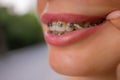 Beautiful young woman with brackets on teeth close up. Royalty Free Stock Photo