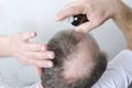 Beauty procedure for hair growth.Man has a problem with hair loss