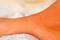 Bed bug bites on a foot Royalty Free Stock Photo